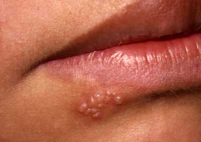 Recurrent Herpes Labialis