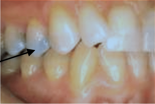 Amalgam Showing through because of thin remaining Enamel