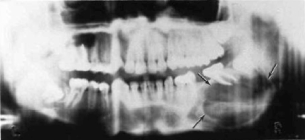 Aneurysmal bone cyst producing expansion of the cortical plates