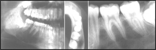 Simple Bone Cyst