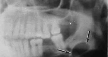 Cysts of the jaw – Pseudocyst