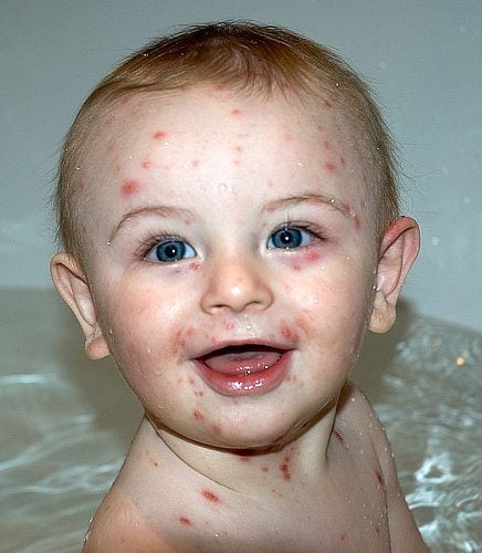 Child With Chicken Pox Child With Chicken Pox