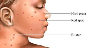 Oral Ulcers – Varicella Zoster Virus