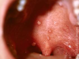 Oral Ulcers Oral Ulcers