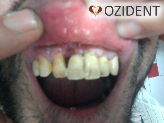 Lateral Tooth Glued to the other teeth