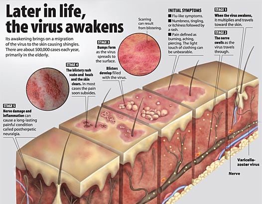 Pathogenesis