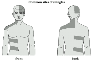 shingles3