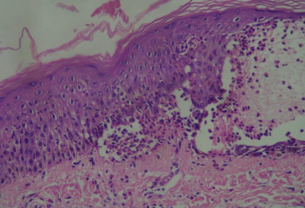 Suprabasial acantholysis 