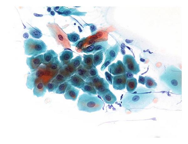 Acantholytic Tzank cells.