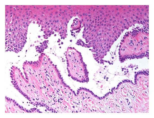 Suprabasial acantholysis near the tips of two adjacent rete pegs is recognized.