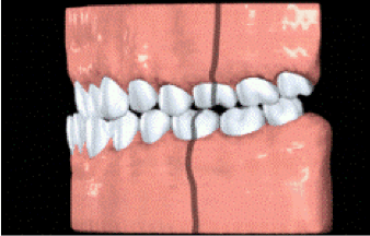 Moderate Class III malocclusion