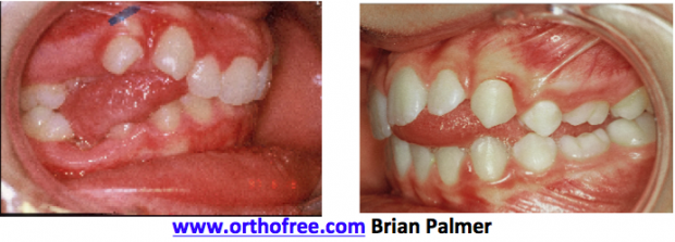  Posterior open bite on left side due to a posterior tongue thrust. 