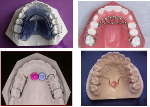 Diffrent methods of treating tongue thrusting 