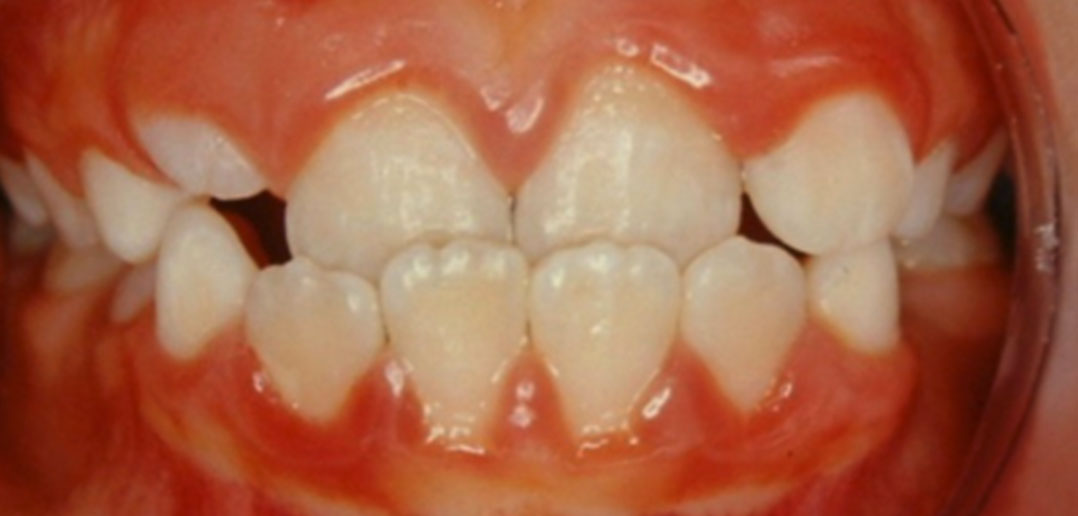 anterior crossbite crossbite