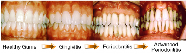 Gingivitis-Progression