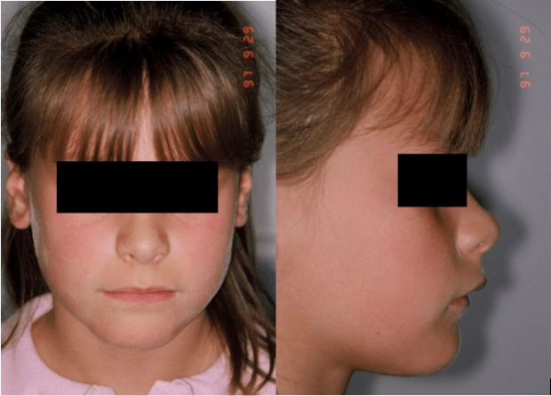 Photographs of face and profile before treatment