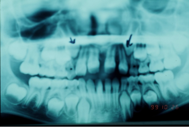 Radiographs before treatment