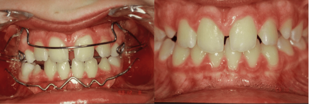 During treatment, interceptive phase, functional appliance Frankel (1 year).