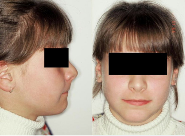 Photographs of face and profile after treatment