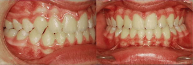Intraoral photographs after treatment-Braces (6 months) Intraoral photographs after treatment-Braces (6 months)