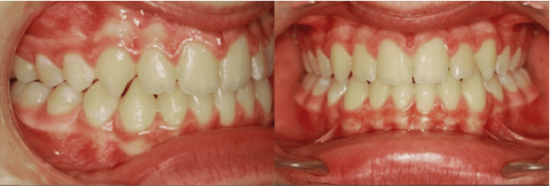 Intraoral photographs after treatment-Braces (6 months)