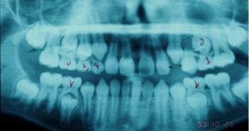 Case: DT10 – Class II Division 1 malocclusion