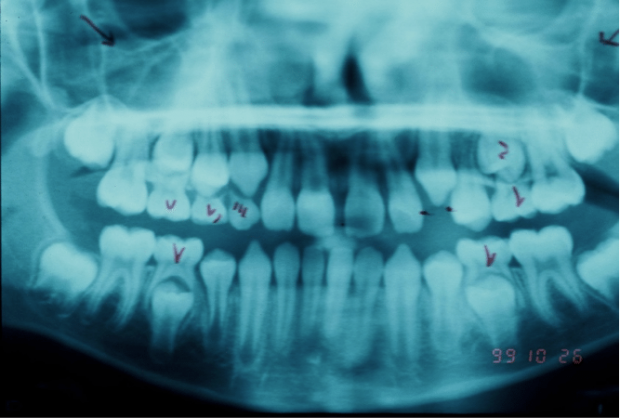 Radiographs after treatment