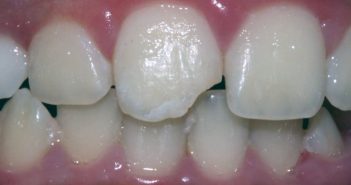 Case: DT11 – Child with Fractured Anterior Tooth