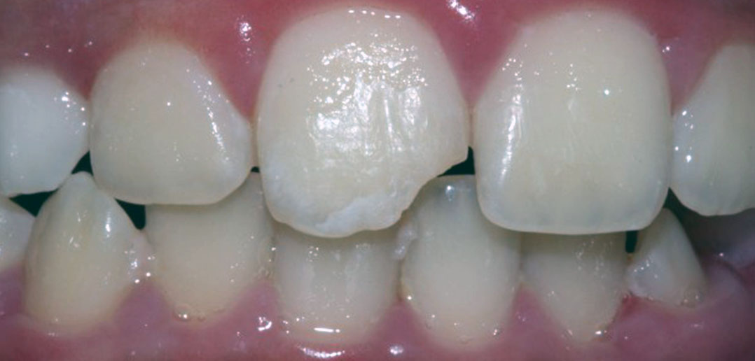 Case DT11 Child with Fractured Anterior Tooth