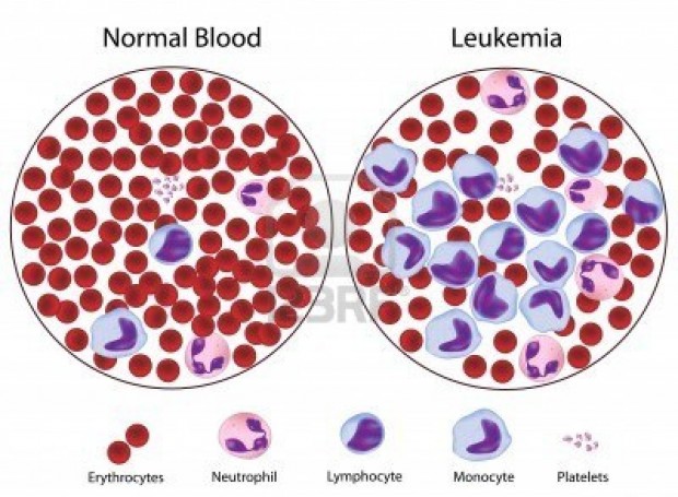 leukemia