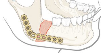 Prosthetic Rehabilitation of mandibular defects
