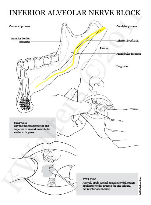 Guide to Inferior nerve block