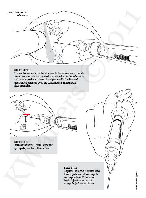 Guide to Inferior nerve block