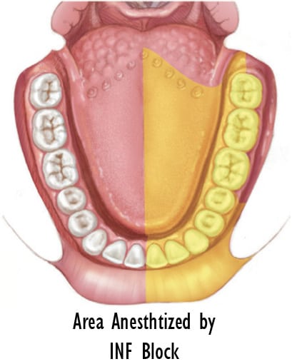 Effected Area 