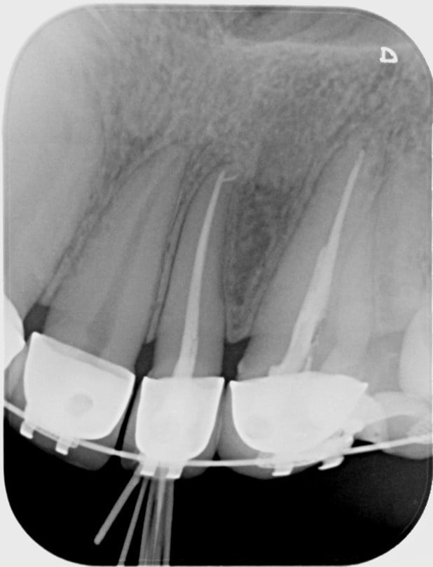 Sealer filled and GP placed | OziDent