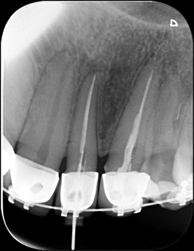 Primary Canal Migration | OziDent