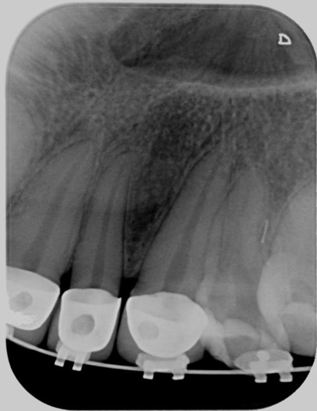 Before Root canal treatment started | OziDent