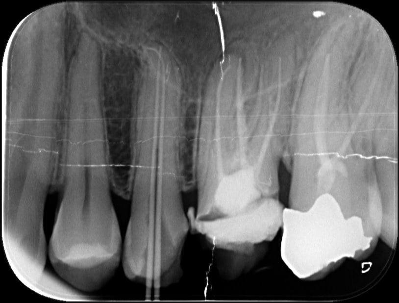 master cone 3 OziDent