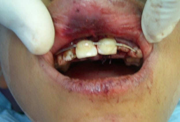 dental photos replantation ozident case