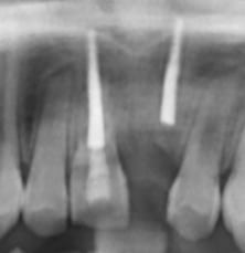 dental radiography or replantation ozident case