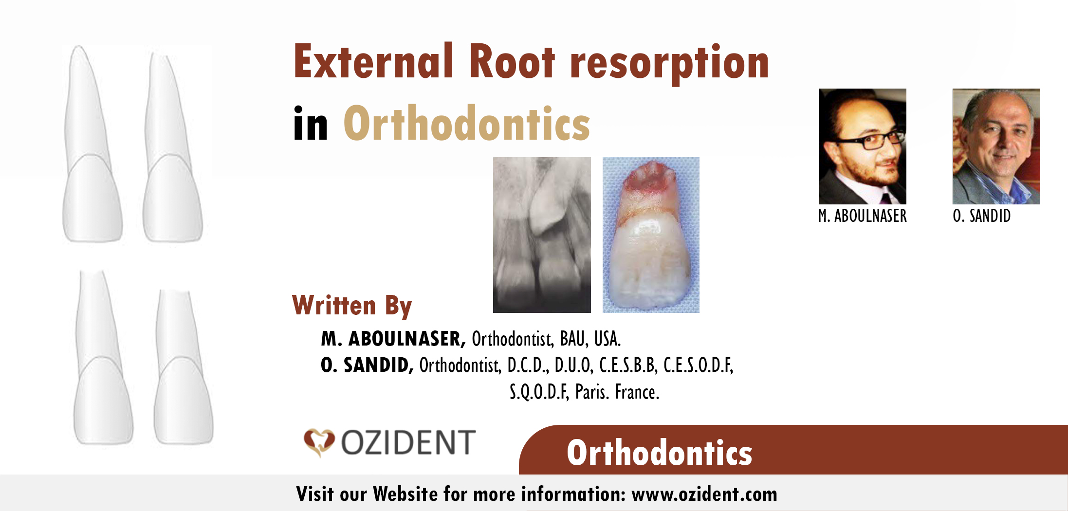 External Root resorption in Orthodontics OziDent